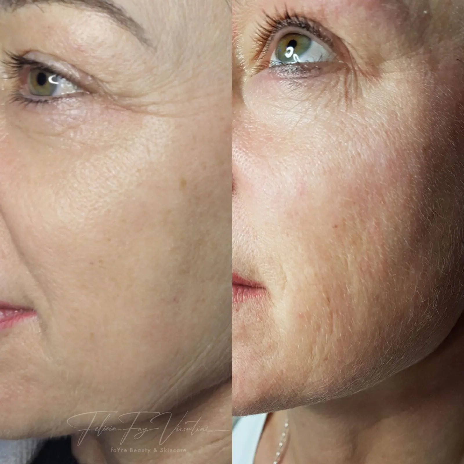 Ergebnis Microneedling