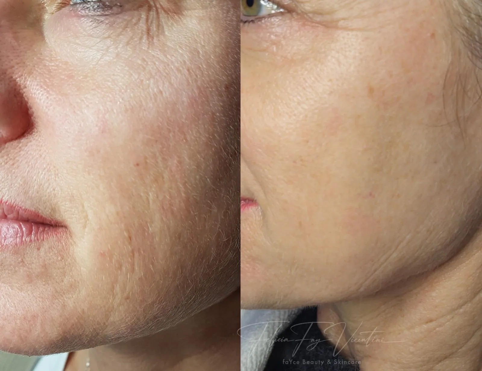 Ergebnis Microneedling
