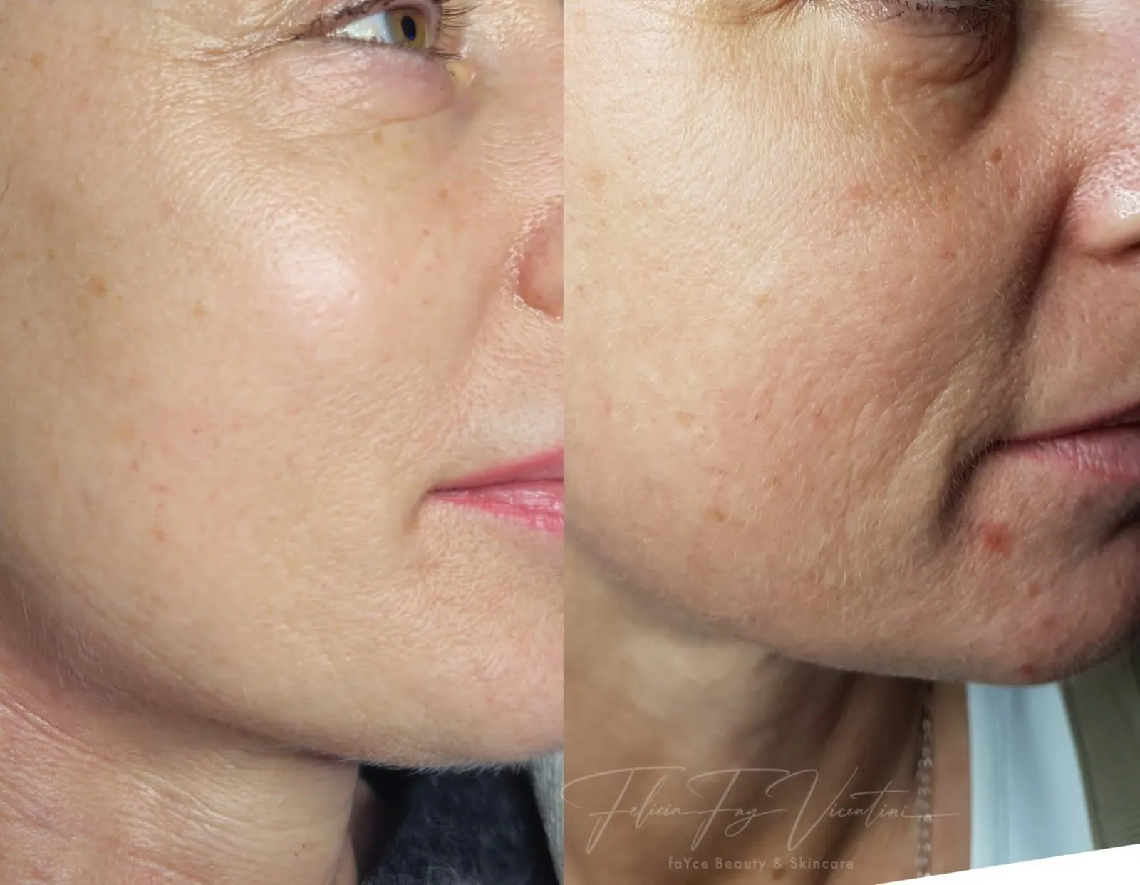 Ergebnis Microneedling